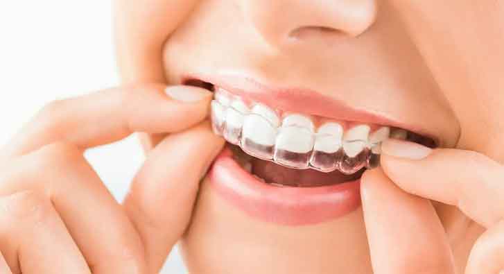 A smiling woman with transparent braces on her teeth.