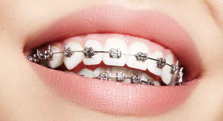 Close-up image of a woman with braces, highlighting her journey to a straighter smile.