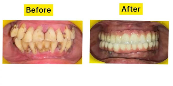  Before and after photos of teeth whitening treatment during Full Mouth Rehabilitation in Indore.