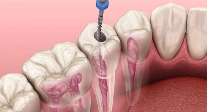 A tooth being drilled by a toothbrush tool.