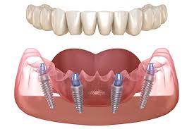 Dental implant and tooth, highlighting Dental Implants Treatment in Indore.