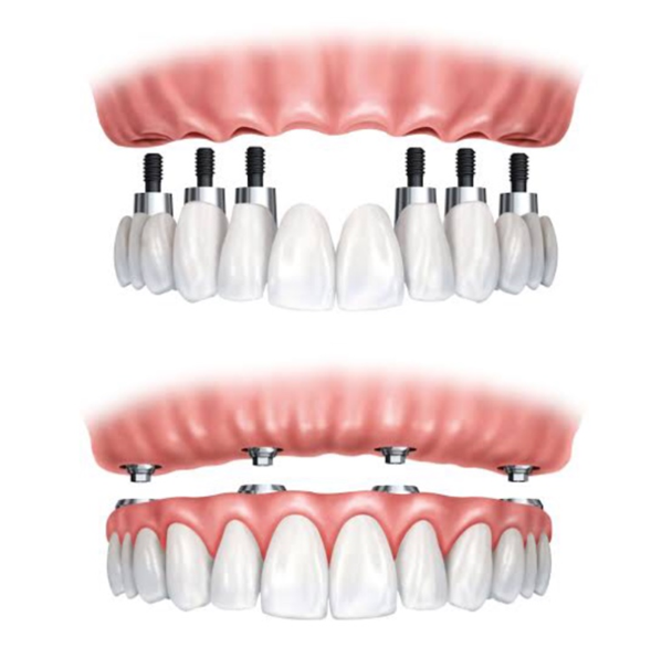 Dental implants and bridges for advanced dental treatment in Indore.