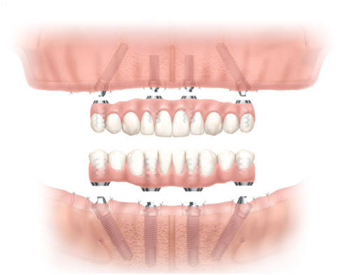 Dental implant and tooth implant shown together, part of Dental Implants Treatment in Indore.