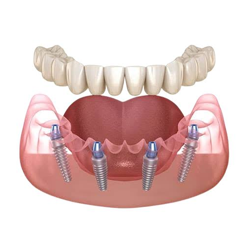 A dental implant with a dental bridge, part of Dental Implants Treatment in Indore.