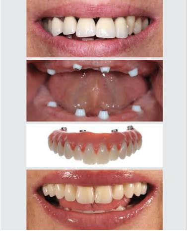 Various kinds of teeth featured in a series of photos. Dental Implants Treatment in Indore.