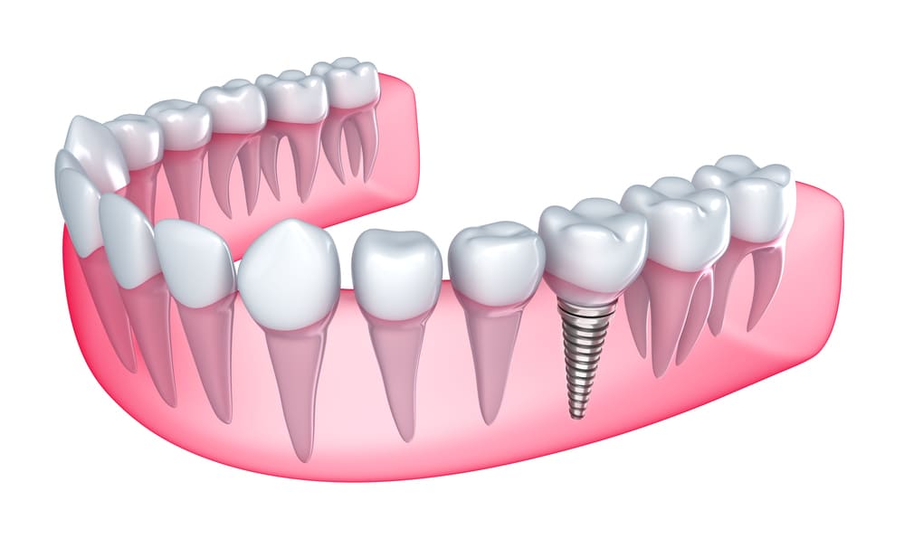 Dental implant and dental crowns, a solution for missing teeth and improved oral health.