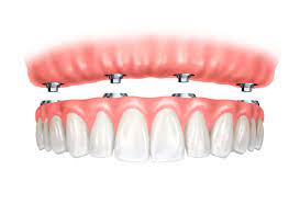 Dental implant, crown, and dentures as part of Dental Implants Treatment in Indore.