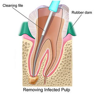 Image of tooth and toothbrush for oral care.